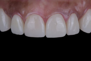 名古屋　インプラント