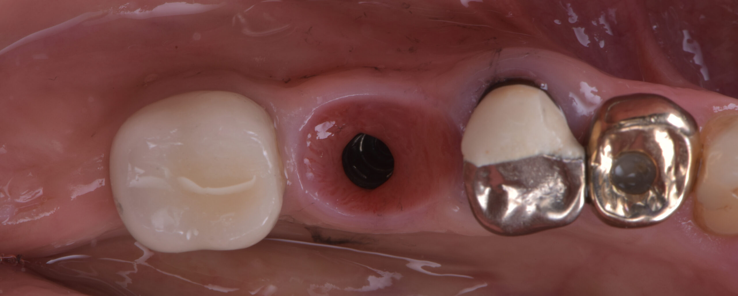 名古屋　インプラント　歯を失う原因３つ