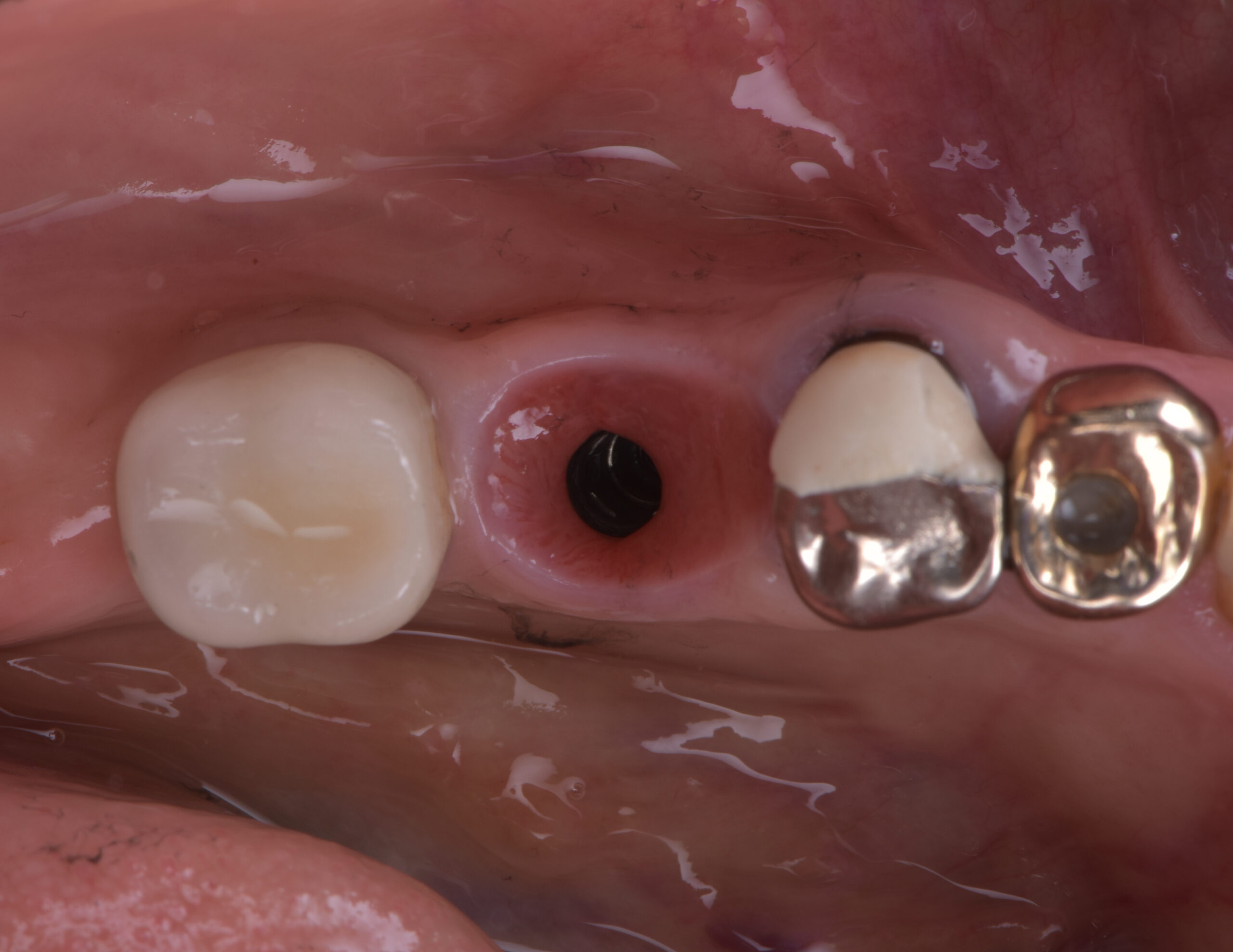名古屋　インプラント　歯を1本失ったらどうする？