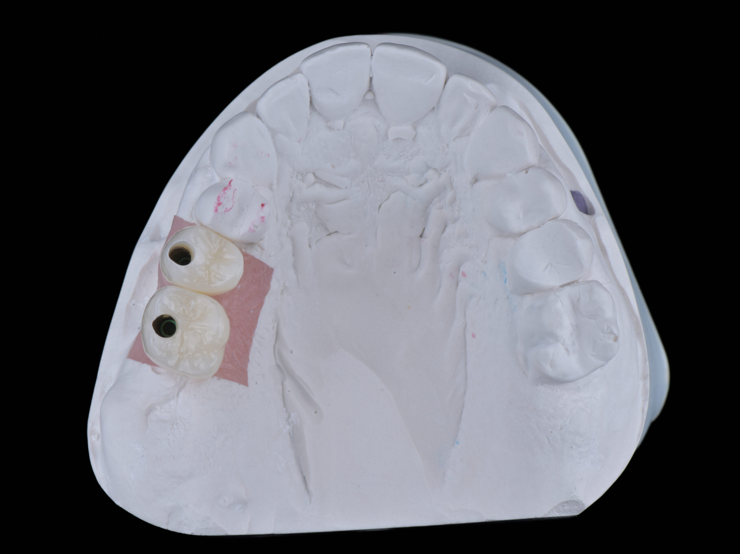 名古屋 奥歯を失ったまま放置するとどうなる？噛み合わせ崩壊のリスク