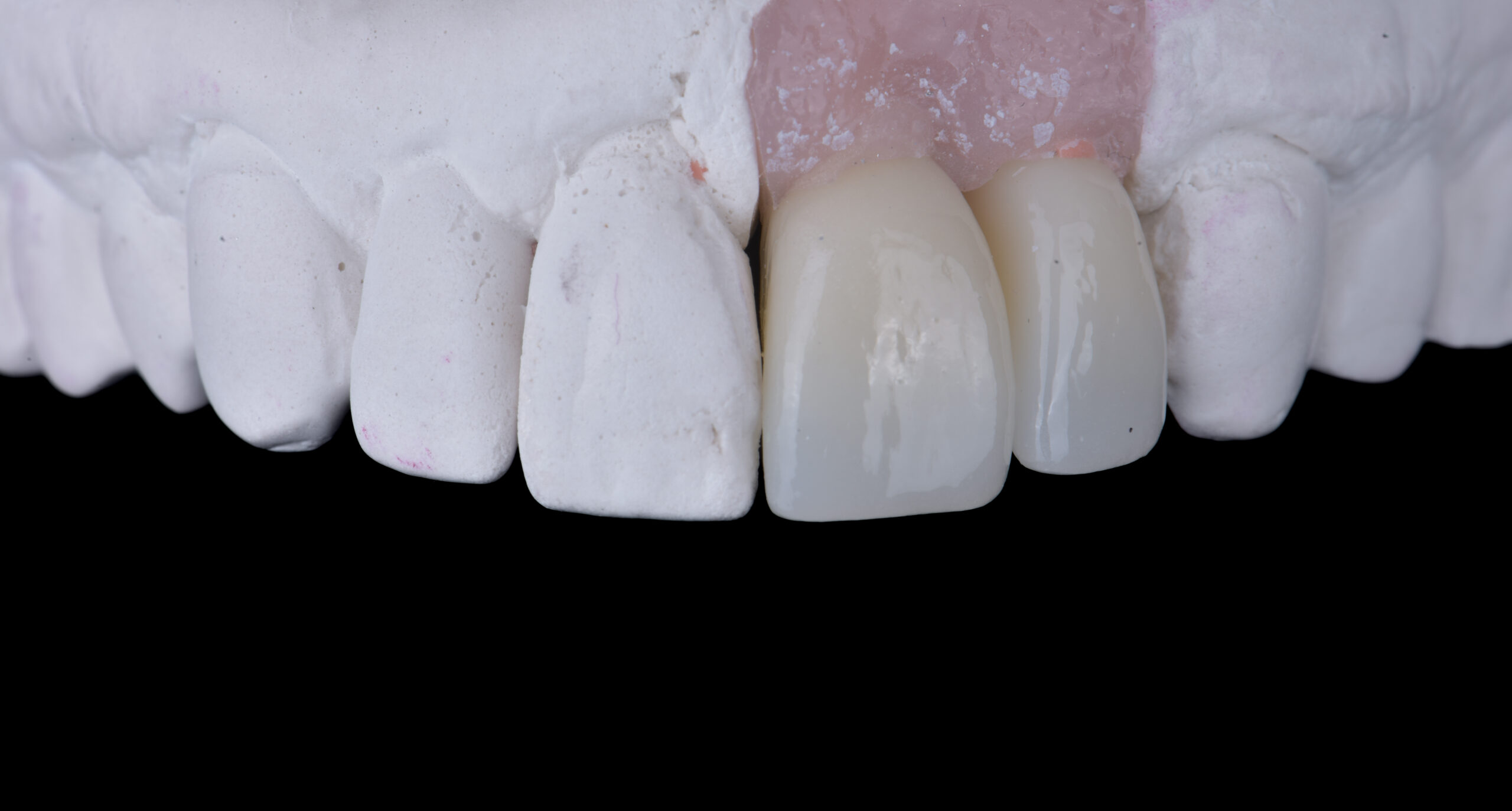 名古屋　セラミックの選び方