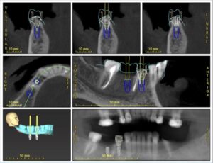 名古屋　インプラント