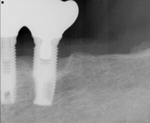 名古屋　インプラント