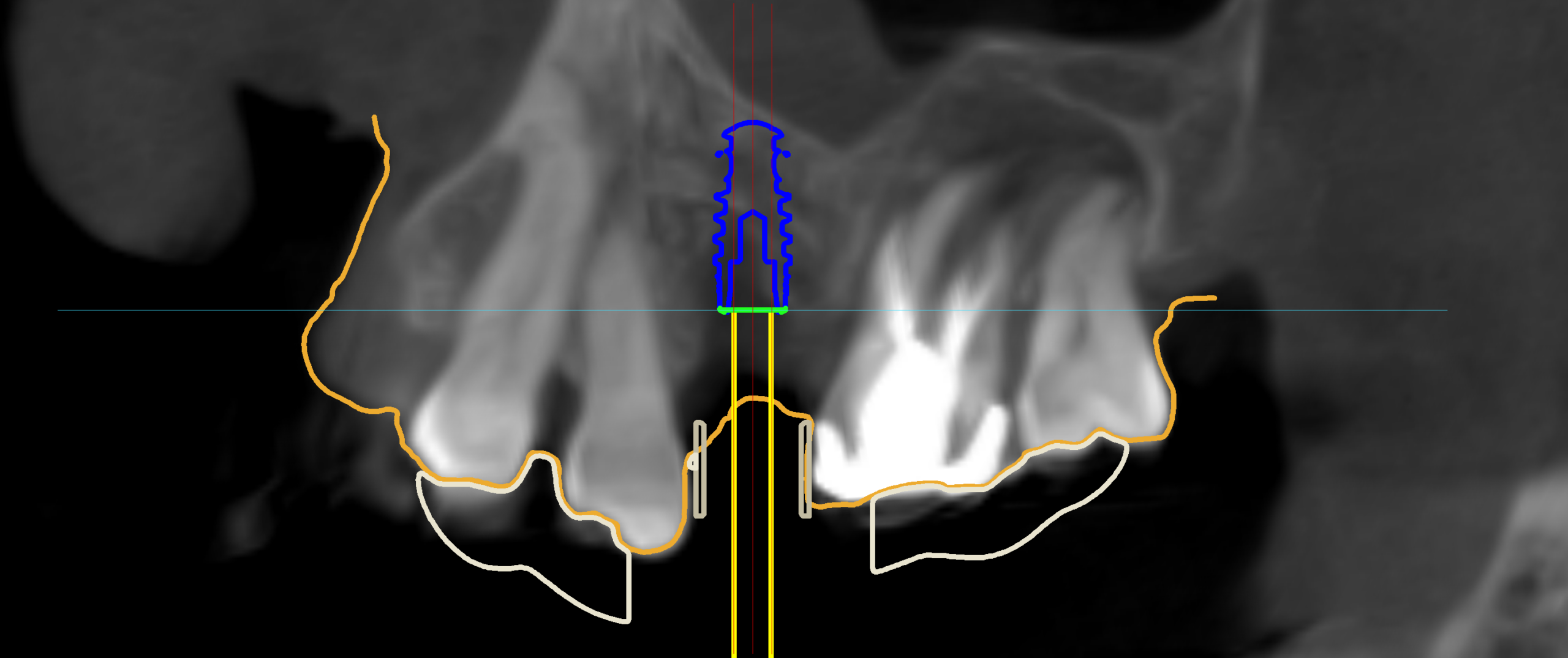 名古屋　インプラントで神経損傷は起こる？CT診断と安全管理の実際