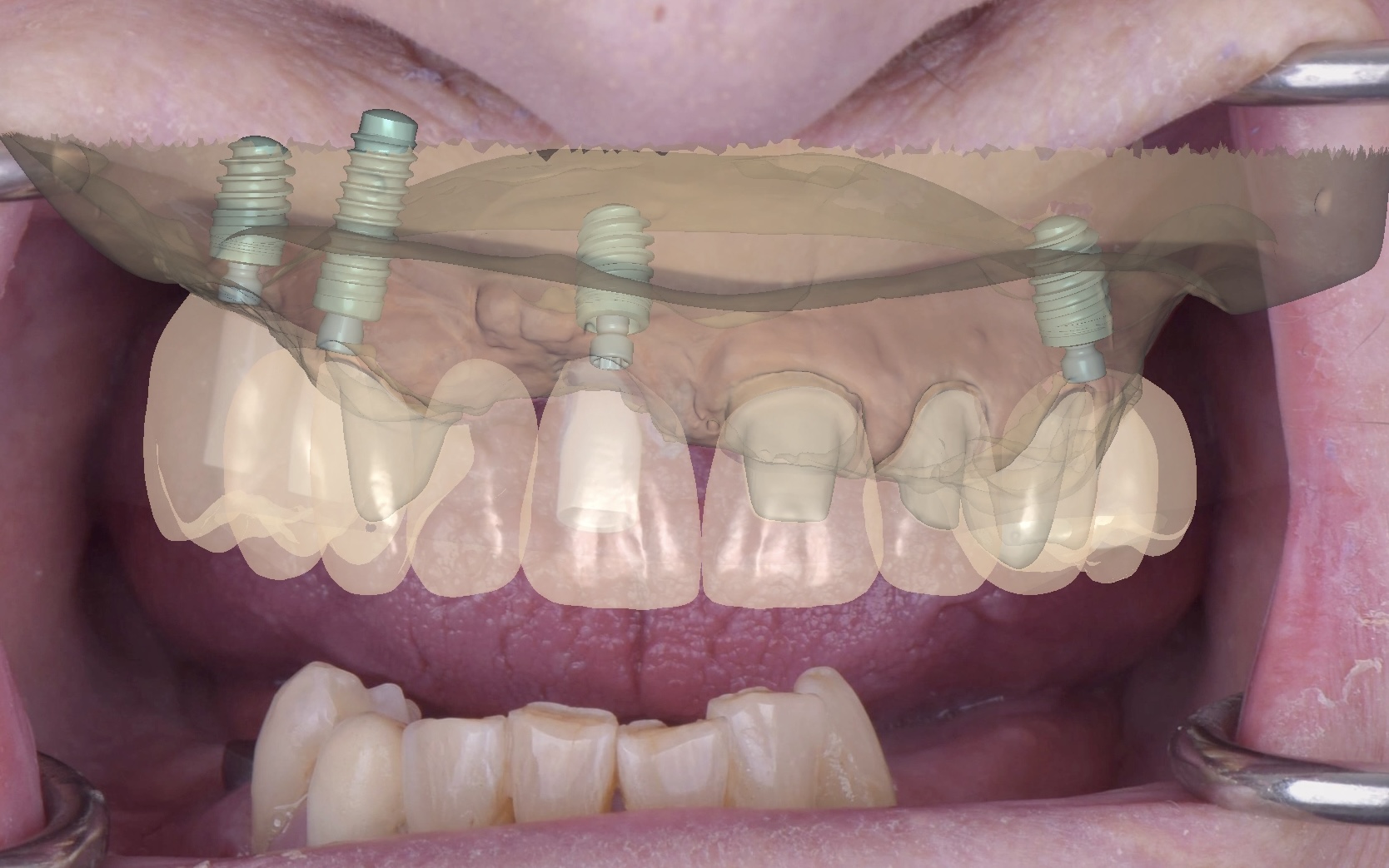 名古屋　インプラントはネジ固定が基本？セメント固定との違いと選び方