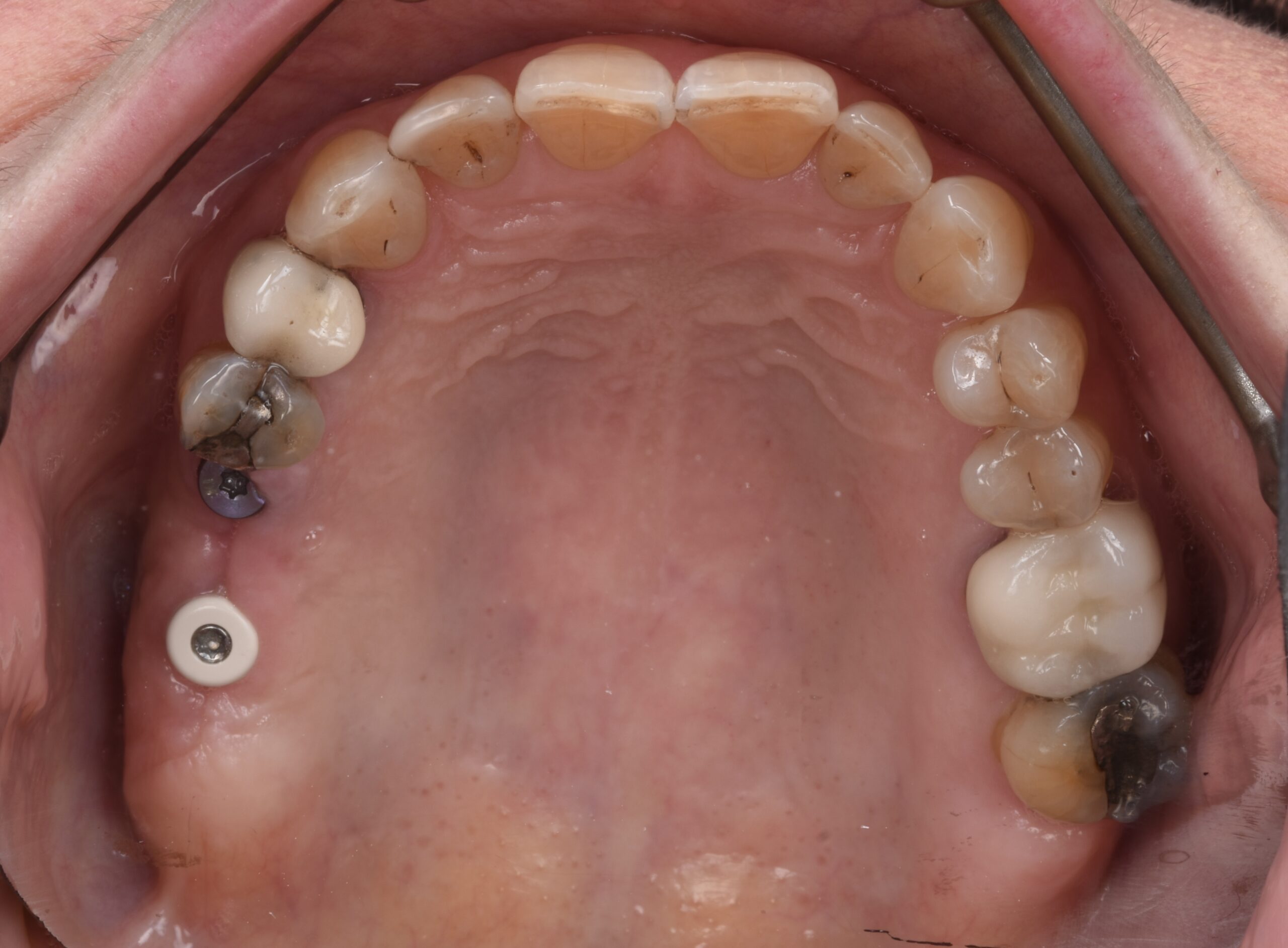 名古屋でインプラント手術後の食事が気になる方へ｜いつから食べられる？避けたい食べ物も解説