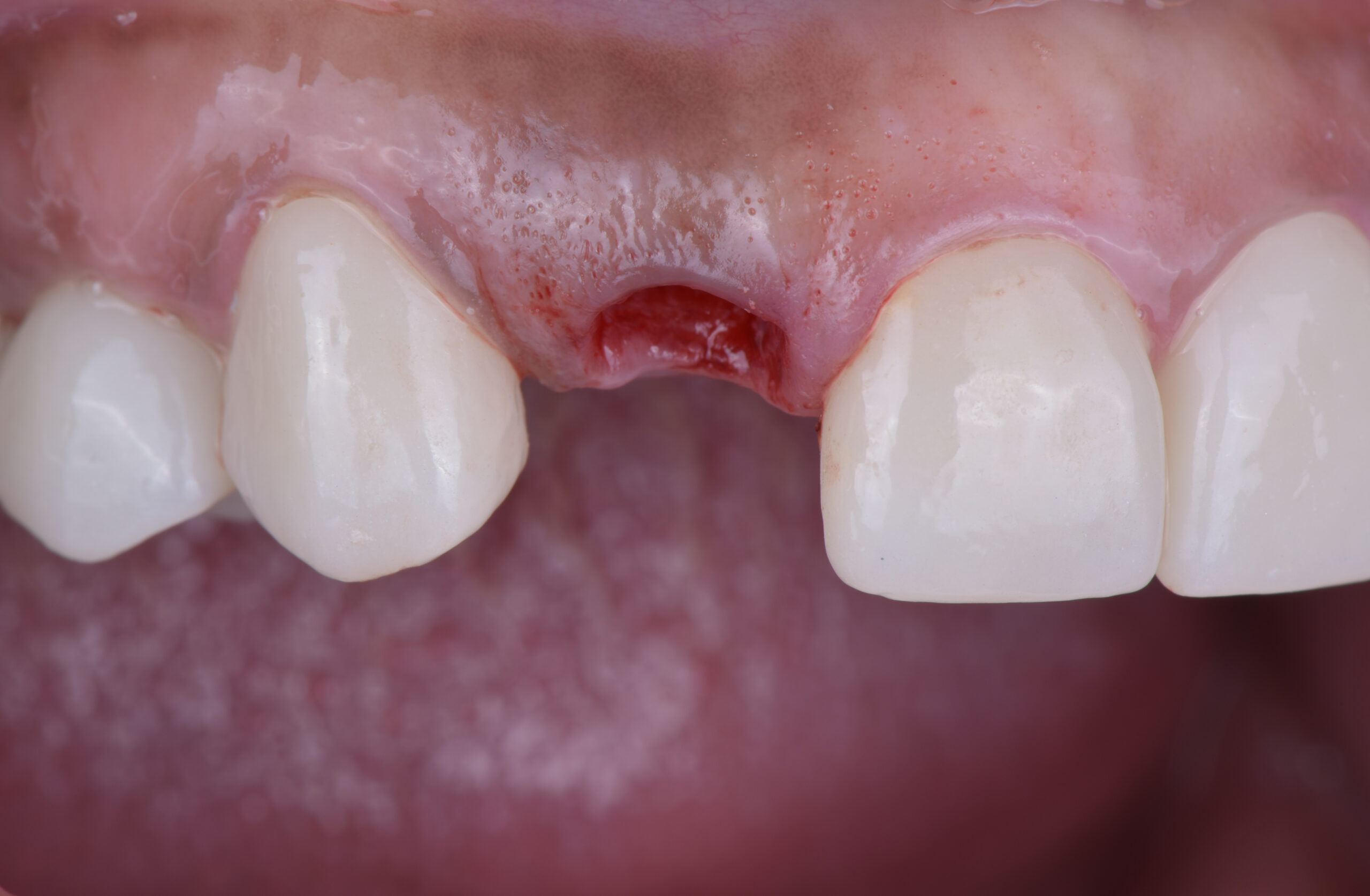 名古屋でインプラント前に骨造成は必要？｜骨が足りない場合の治療