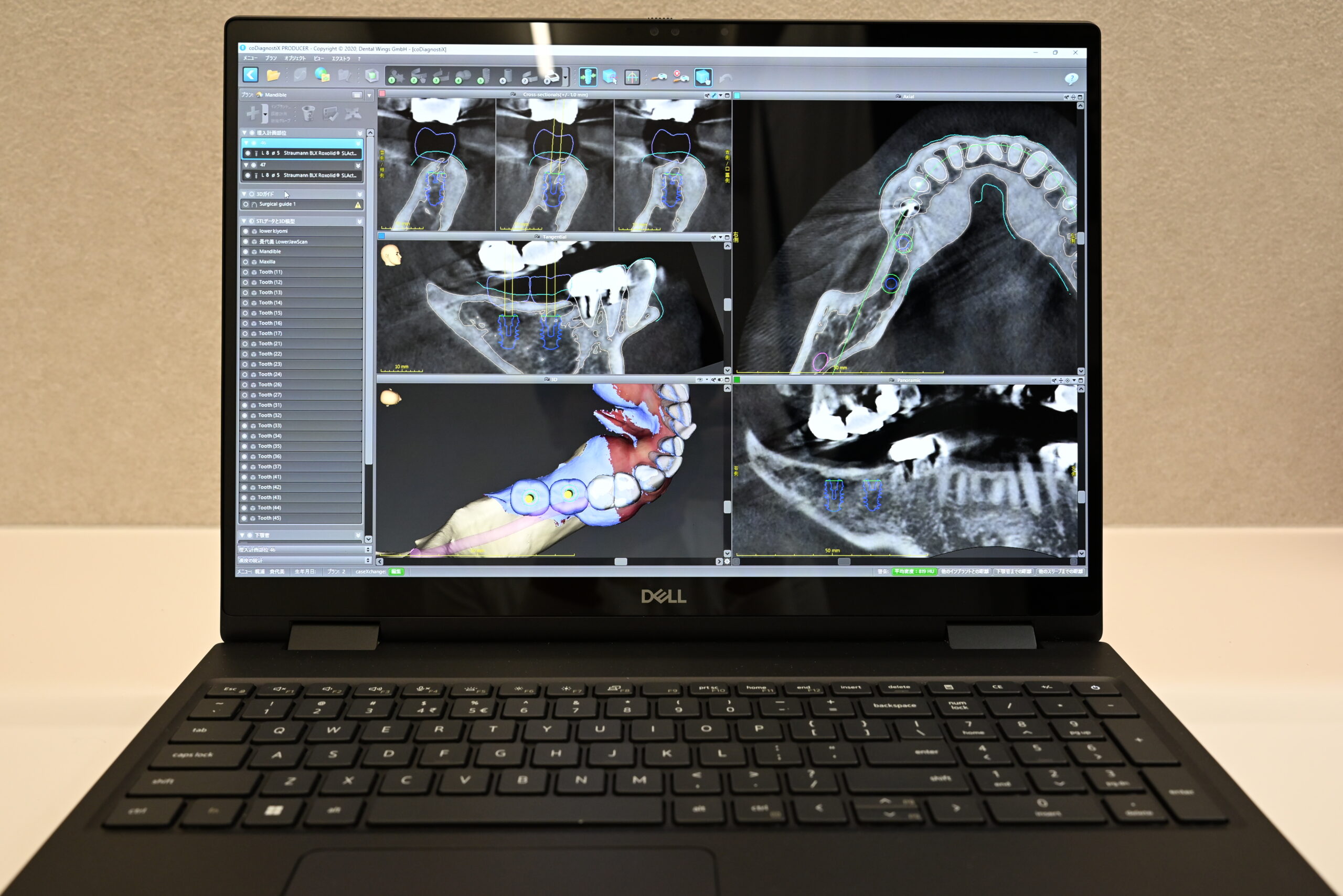 歯科用コーンビームCT｜オールオン4の埋入計画の土台となる装置｜名古屋Eden Dental Office