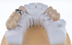 名古屋　インプラント