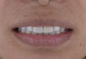 名古屋　インプラント