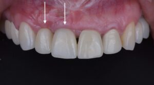 名古屋　インプラント