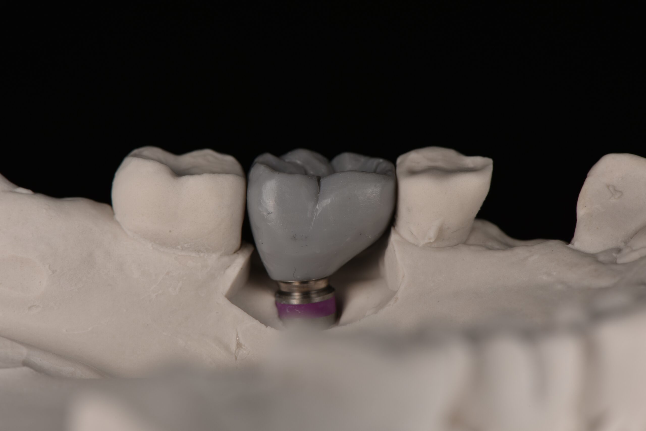 名古屋 　インプラント　奥歯を失ったときの治療選択