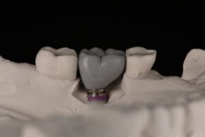 インプラント 名古屋