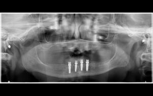 名古屋　インプラント