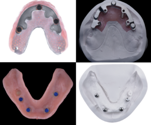 名古屋 インプラント