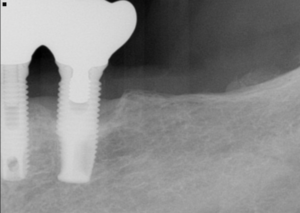 名古屋　インプラント