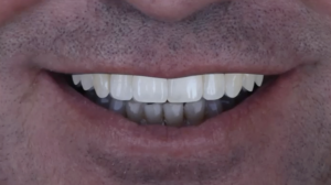 名古屋　インプラント