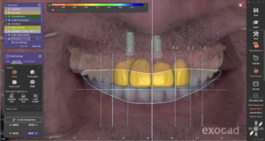 名古屋　インプラント