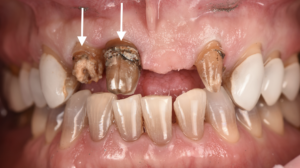 名古屋　インプラント