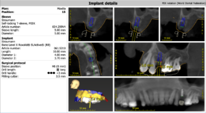 名古屋　インプラント