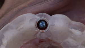 名古屋　インプラント