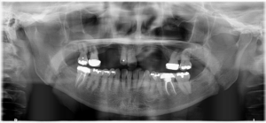 名古屋　インプラント
