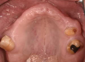 名古屋　インプラント