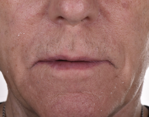 名古屋　インプラント