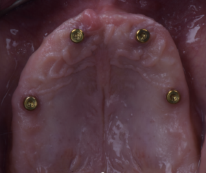 名古屋　インプラント