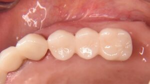 名古屋　インプラント