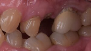 名古屋　インプラント