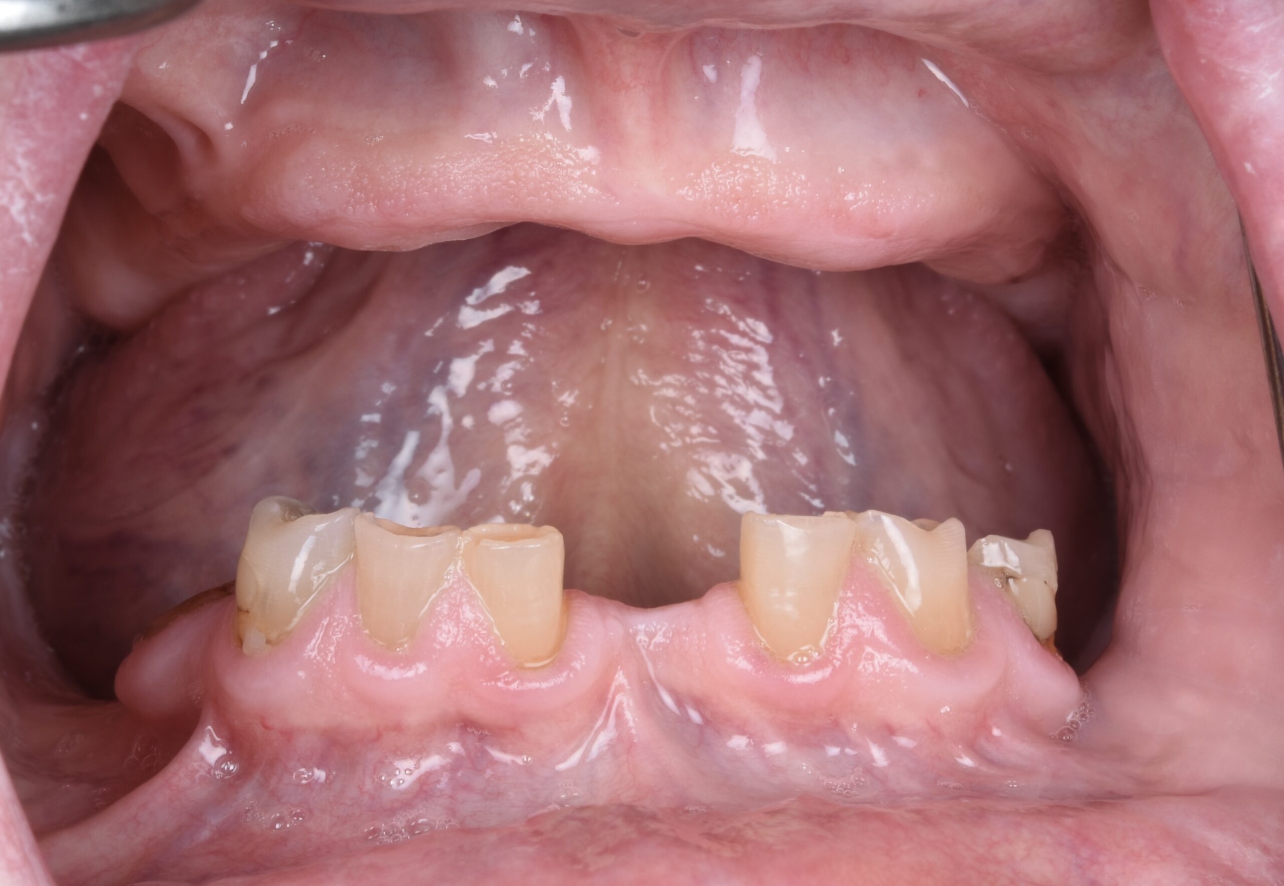 歯がほとんどない方は何から相談すべき？｜名古屋で最初の一歩を整理