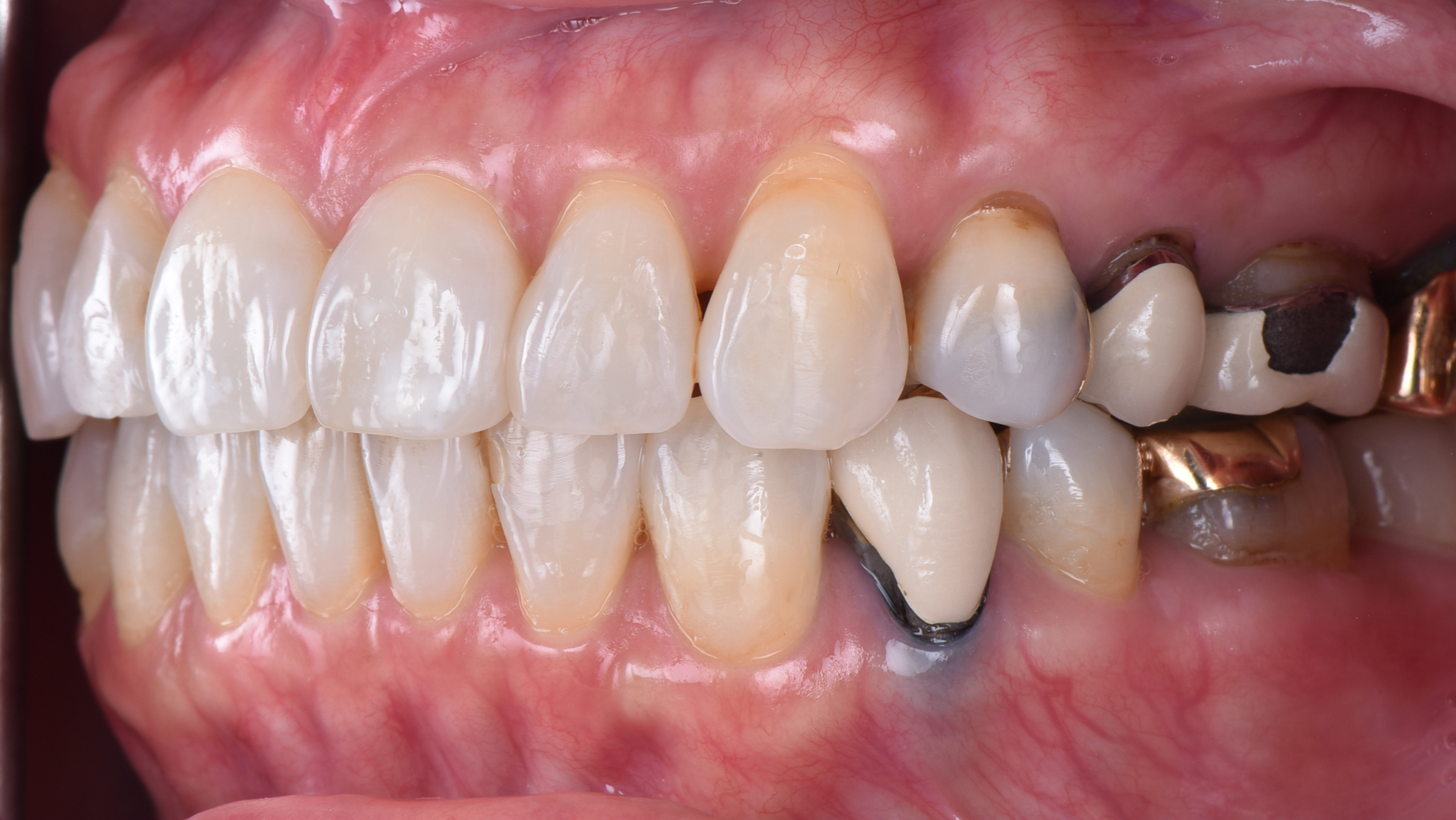 名古屋 結合組織移植・遊離歯肉移植とは何か｜歯ぐき移植と診断の考え方