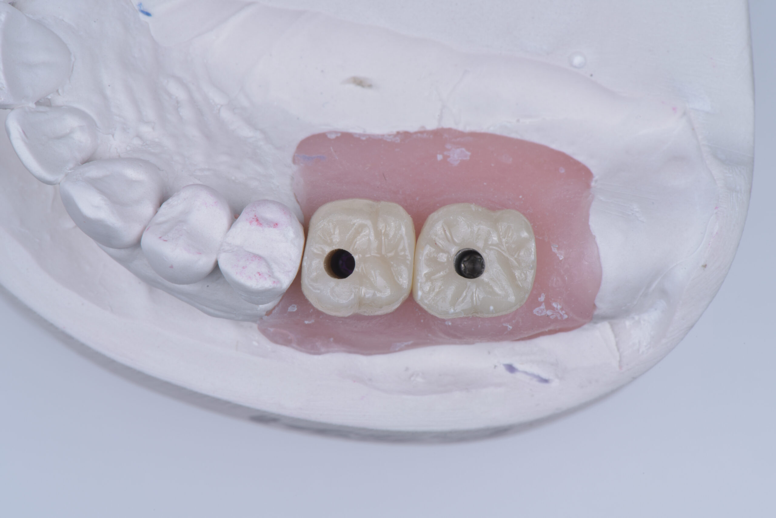 名古屋　歯がボロボロでも入れ歯以外はある？考え方を整理