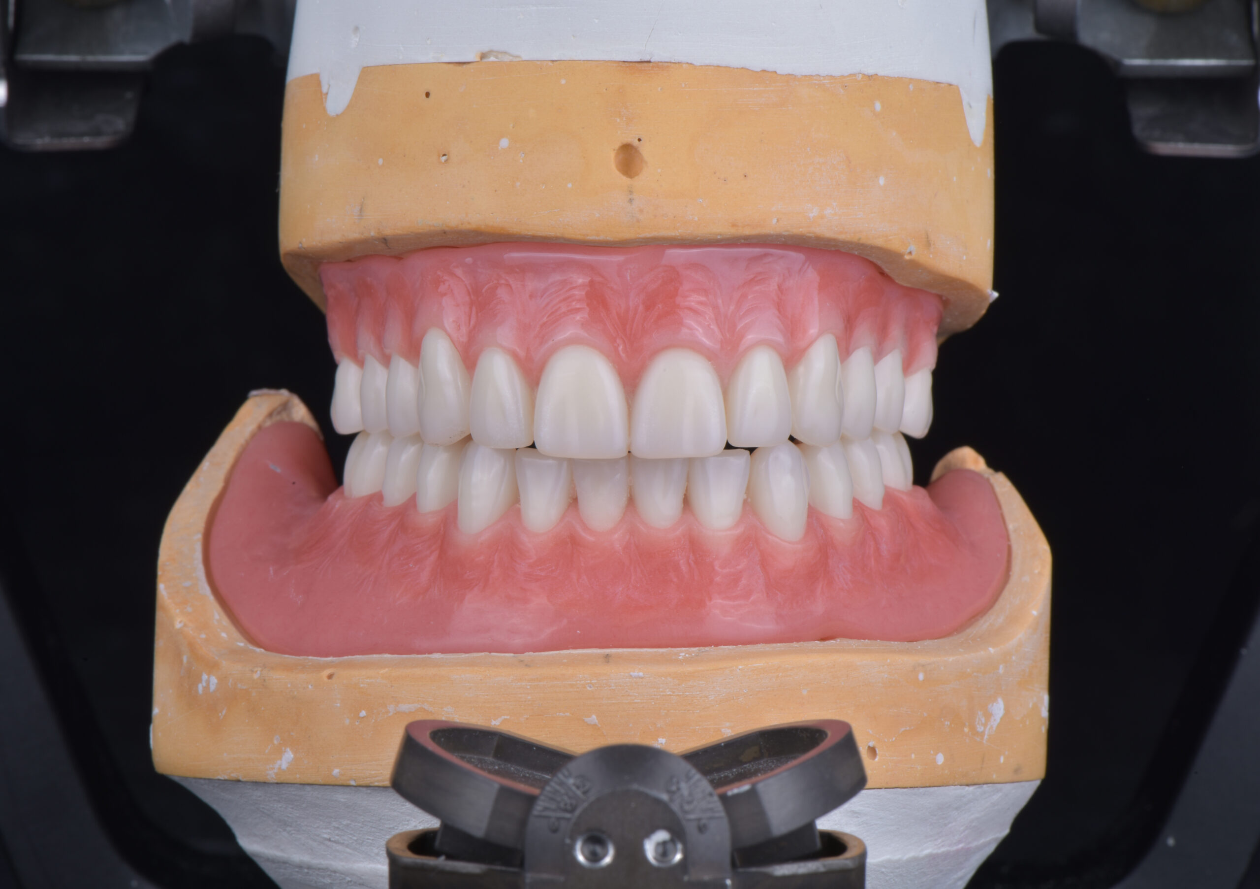 名古屋で多数歯欠損を短期間で治したい方へ｜治療期間と判断基準を整理