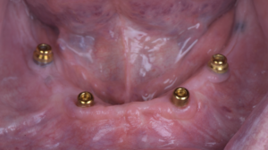 名古屋　インプラント