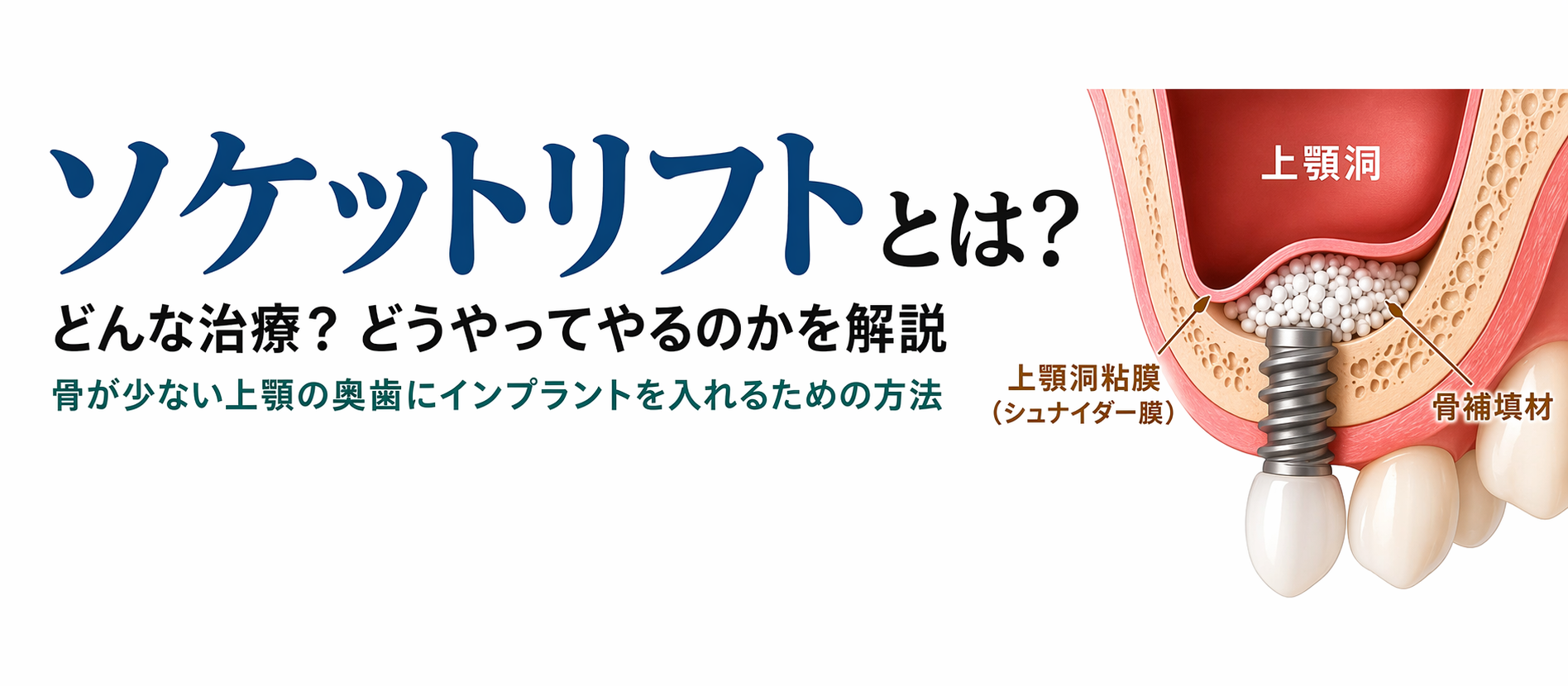 名古屋 　インプラント ソケットリフトとは何かを解説