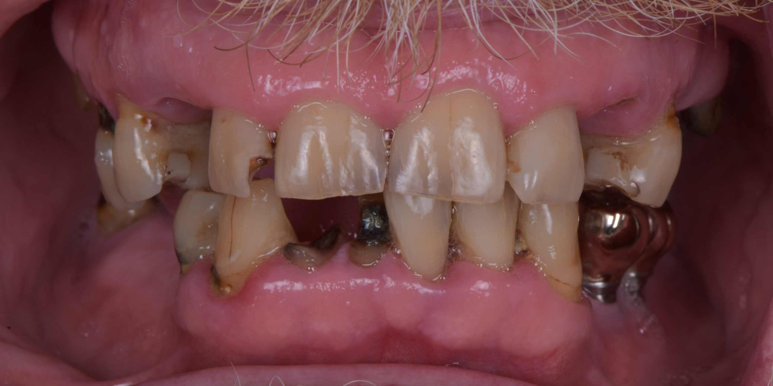 オールオン4症例｜治療前｜残存歯わずか・インプラント支持の入れ歯検討｜名古屋Eden Dental Office