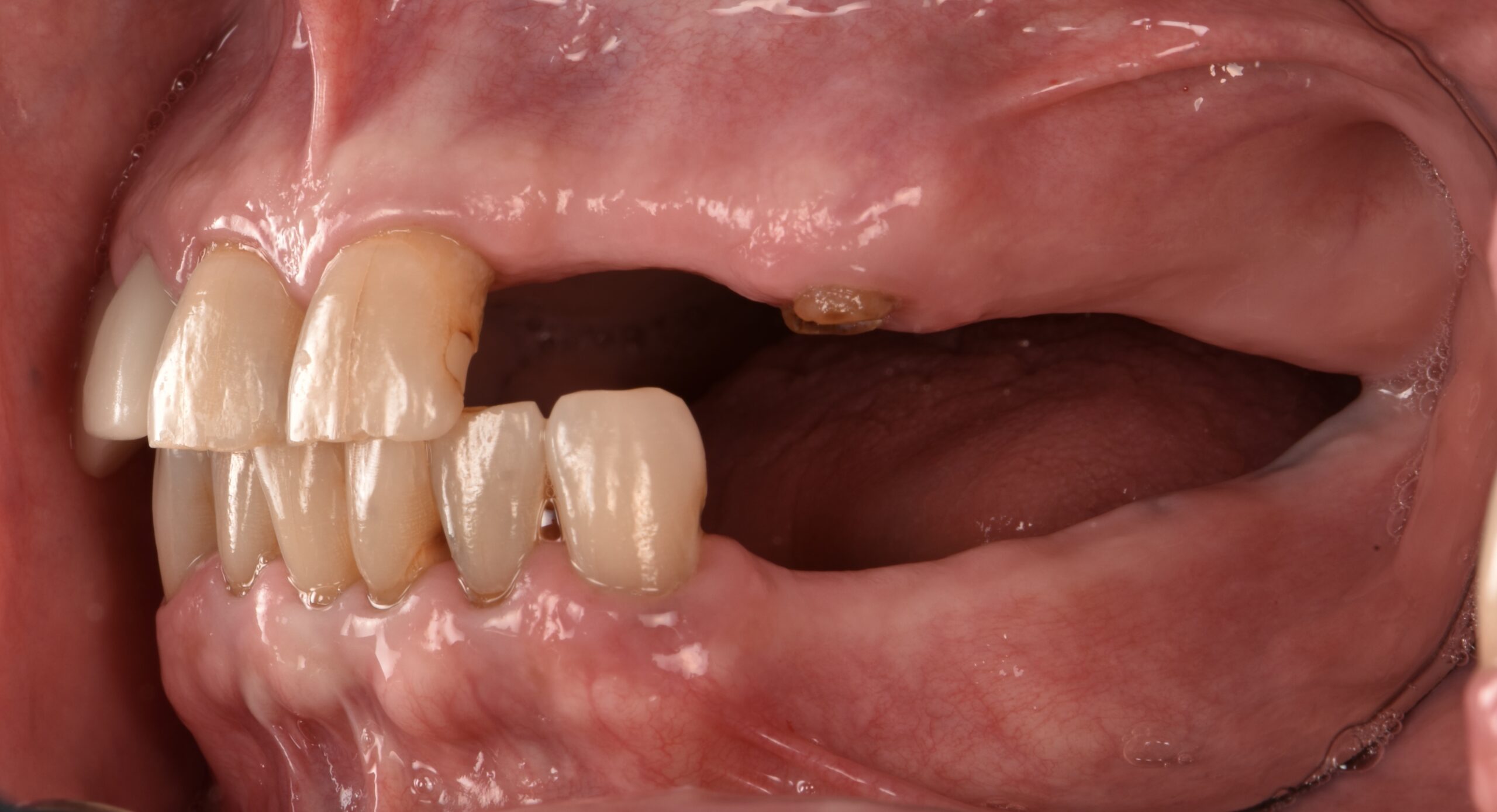 オールオン4治療｜歯を多く失った方の治療設計｜名古屋Eden Dental Office