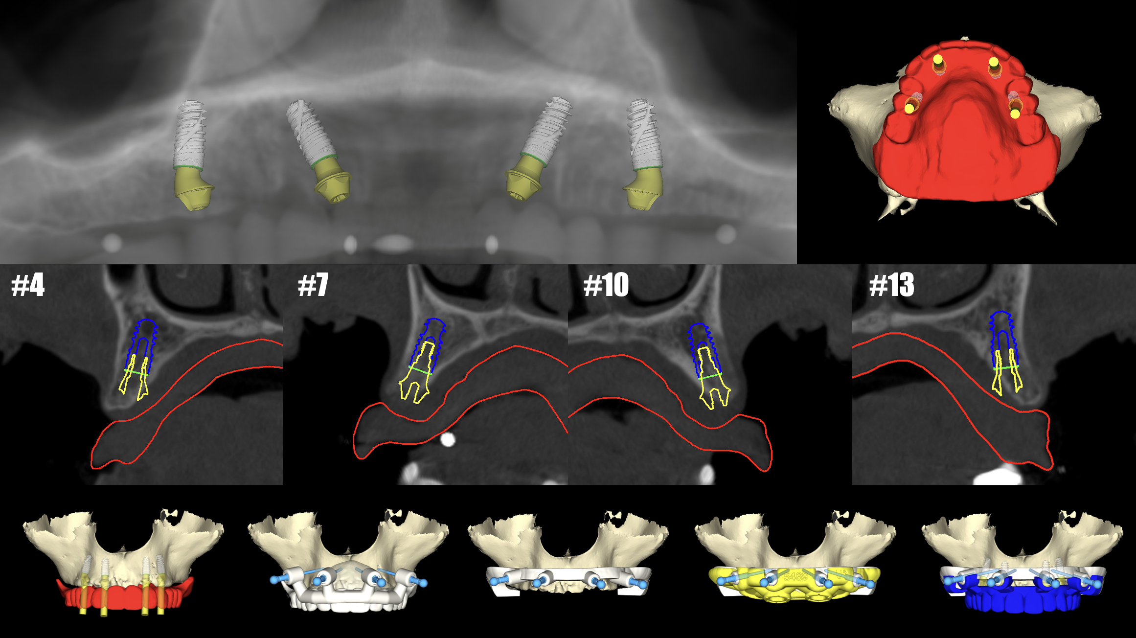 オールオン4のCT診断・補綴主導設計シミュレーション｜名古屋Eden Dental Office