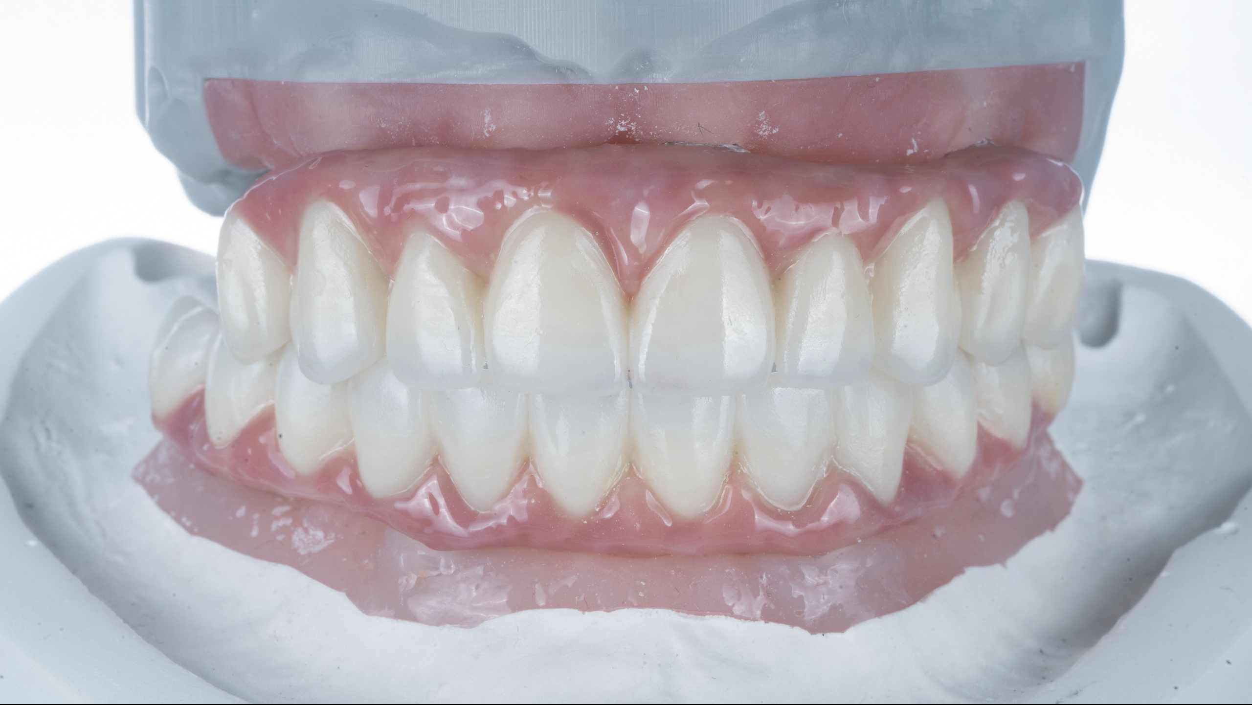 オールオン4治療の流れ｜最終補綴の製作・装着｜名古屋Eden Dental Office
