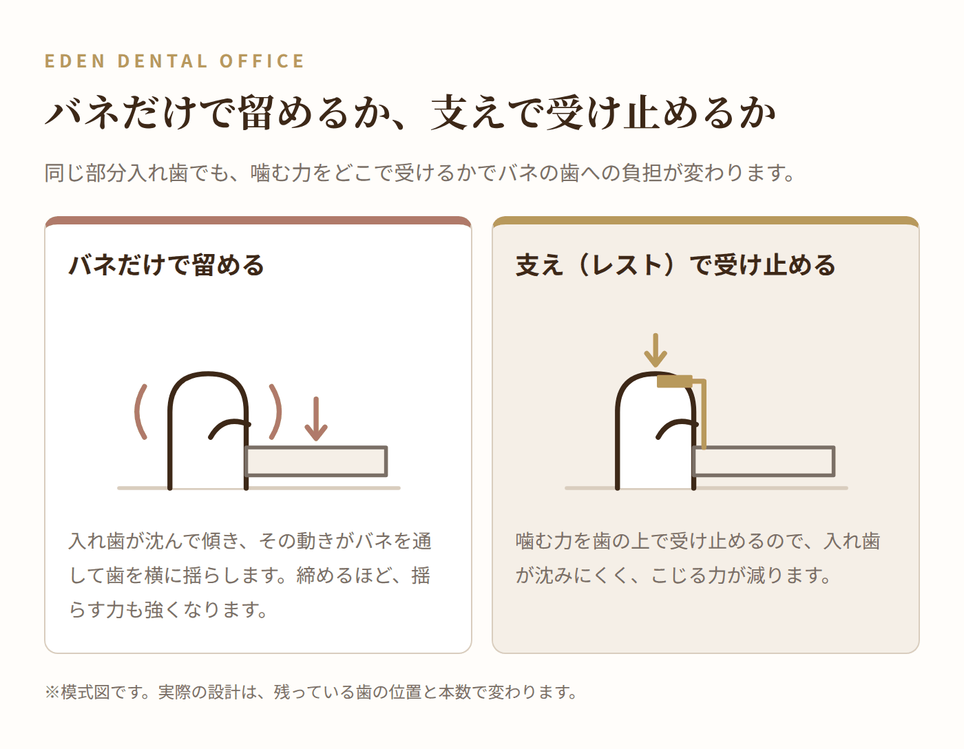バネだけで留める部分入れ歯と、支え(レスト)で受け止める部分入れ歯の比較図