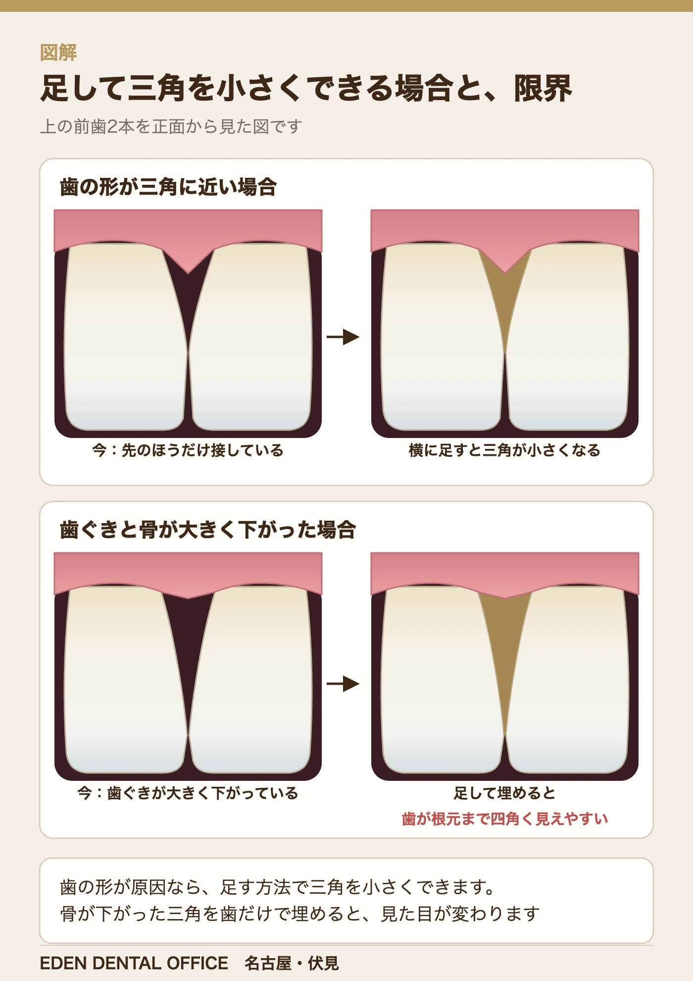 足して三角を小さくできる場合と、限界|名古屋エデンデンタルオフィス