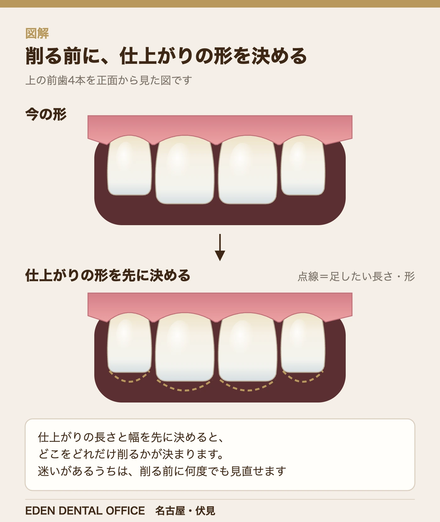 削る前に、仕上がりの形を決める|名古屋エデンデンタルオフィス