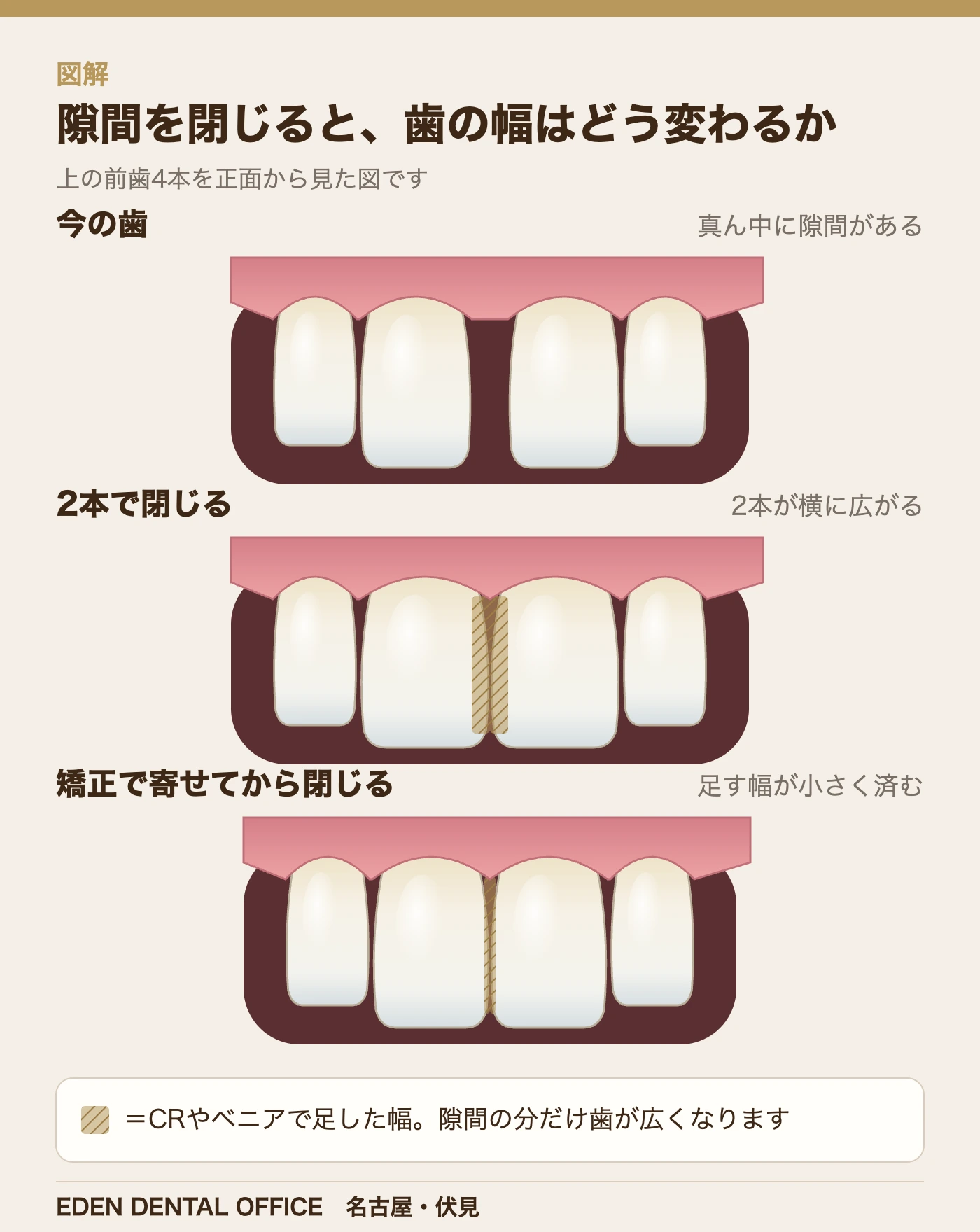 隙間を閉じると歯の幅はどう変わるか(上の前歯4本の正面)|名古屋エデンデンタルオフィス