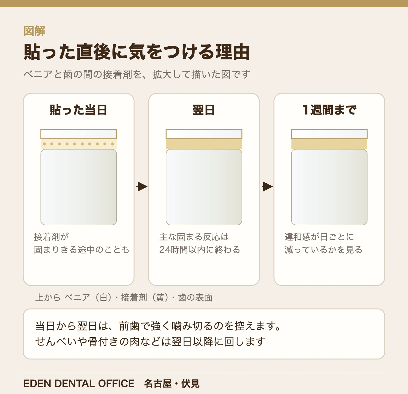 貼った直後に気をつける理由|名古屋エデンデンタルオフィス