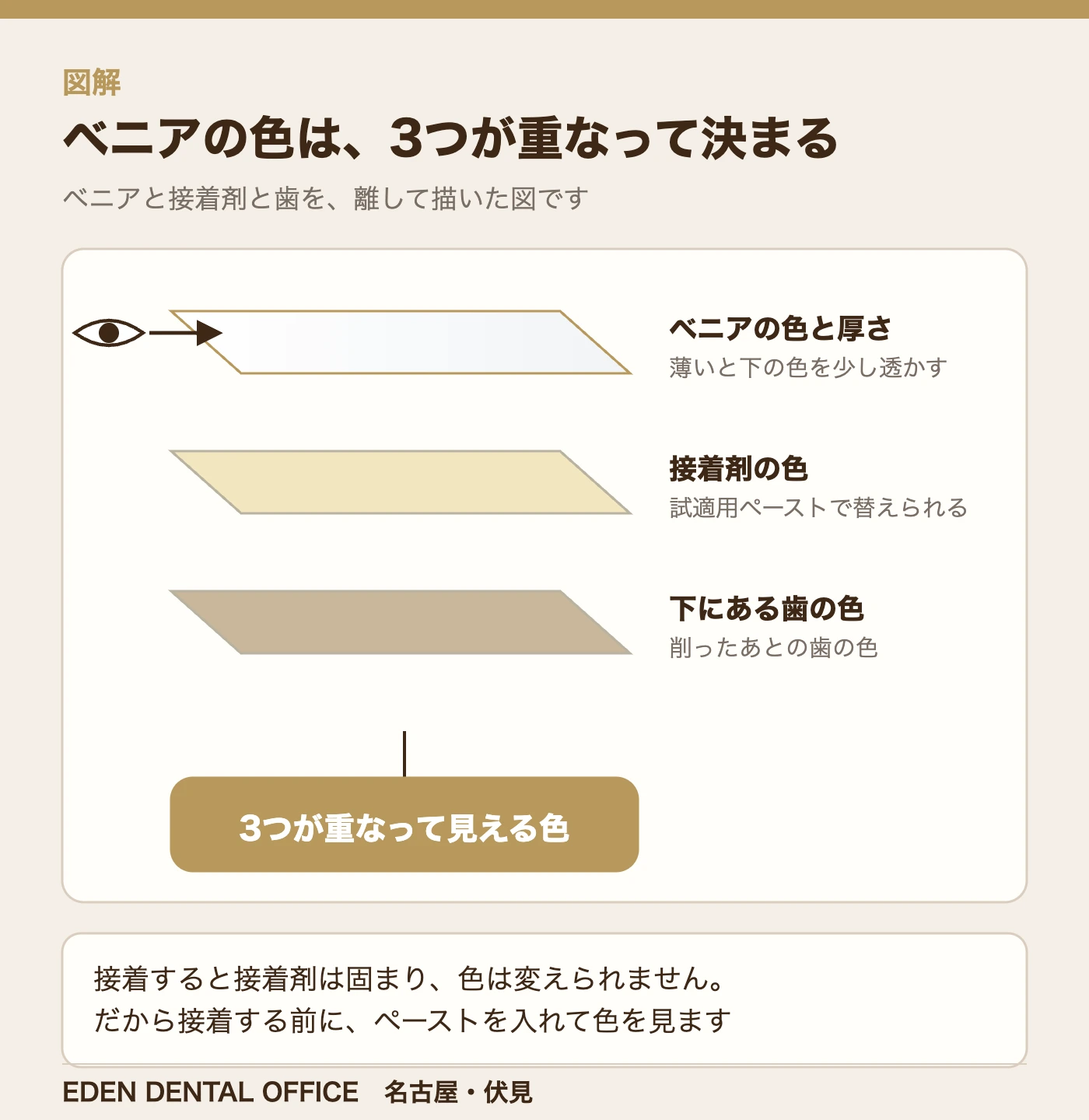 ベニアの色は、3つが重なって決まる|名古屋エデンデンタルオフィス