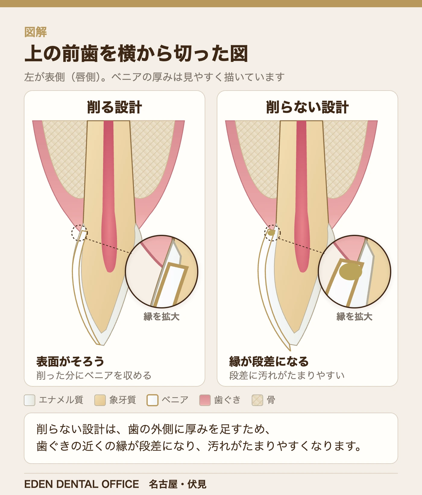 上の前歯を横から切った図:削る設計と削らない設計のベニアの縁|名古屋エデンデンタルオフィス
