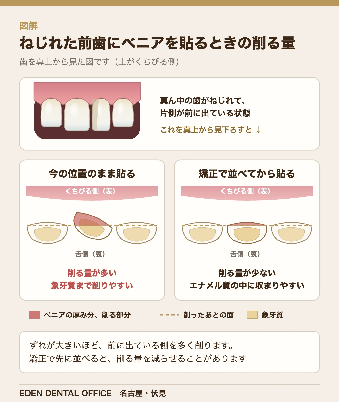 ねじれた前歯にベニアを貼るときの削る量|名古屋エデンデンタルオフィス